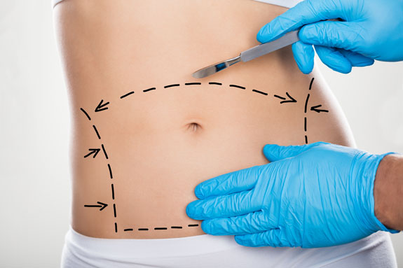 Abdominoplastik Rheingau